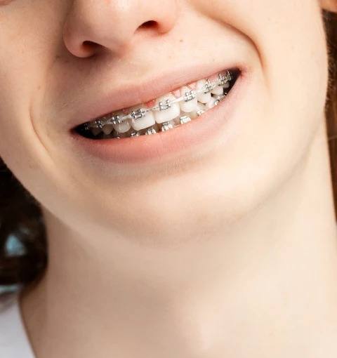 Après la pose d’un appareil dentaire