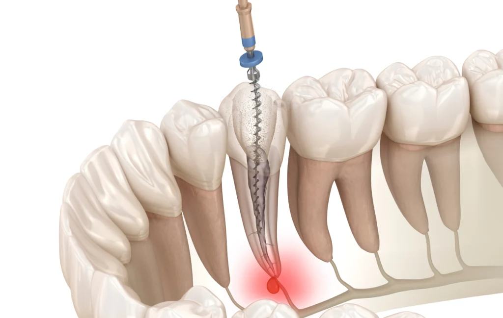 consultation dentiste decines charpieu suivi endodontie Dévitalisation Dentistes à Décines-Charpieu, Cabinet dentaire Grand Large