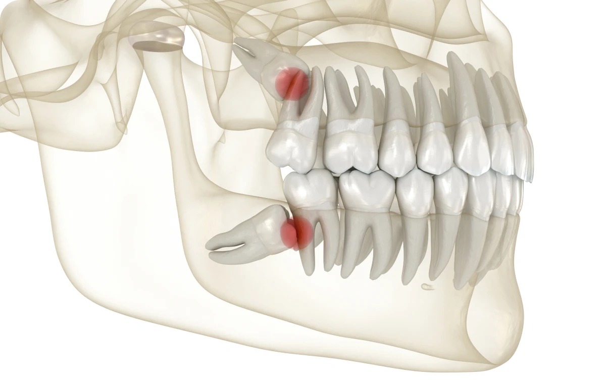 dents sagesse extraction decines charpieu Extraction dentaire Dentistes à Décines-Charpieu, Cabinet dentaire Grand Large
