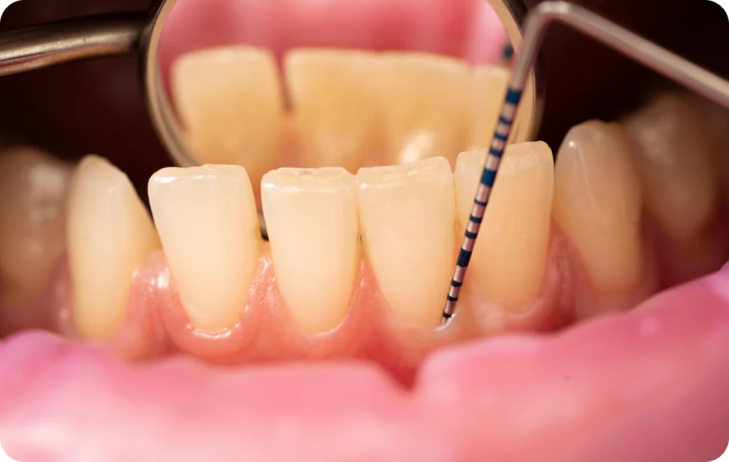 detartrage decines charpieu hygiene buccale detartrage decines charpieu hygiene buccale Détartrage Dentistes à Décines-Charpieu, Cabinet dentaire Grand Large