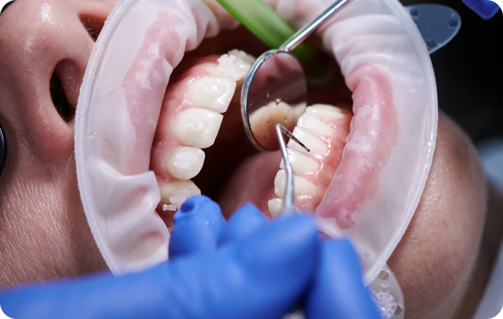 detartrage decines charpieu soins gencives Soin des gencives Dentistes à Décines-Charpieu, Cabinet dentaire Grand Large