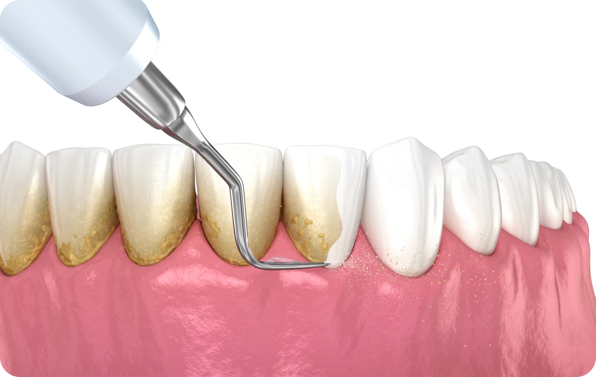 detartrage decines charpieu Détartrage Dentistes à Décines-Charpieu, Cabinet dentaire Grand Large