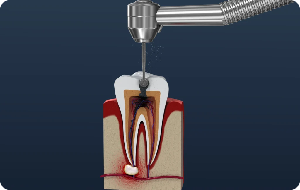 endodontie consultation dentiste decines charpieu traitement Soins dentaires conservatoires Dentistes à Décines-Charpieu, Cabinet dentaire Grand Large