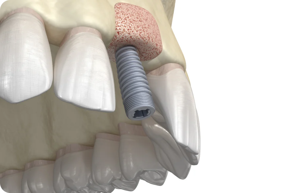 greffe osseuse decines charpieu chirurgie greffe osseuse decines charpieu chirurgie Greffe osseuse Dentistes à Décines-Charpieu, Cabinet dentaire Grand Large