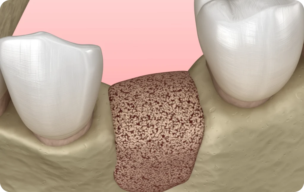 greffe osseuse decines charpieu volume osseux greffe osseuse decines charpieu volume osseux Greffe osseuse Dentistes à Décines-Charpieu, Cabinet dentaire Grand Large